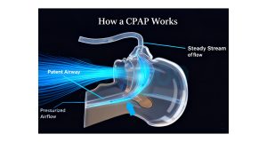 The CPAP humidifier is an essential accessory for CPAP therapy, adding moisture to pressurized air to prevent dry nasal passages and sore throats. Compatible with most CPAP and Auto CPAP machines, it features adjustable humidity levels to suit individual preferences. The compact, easy-to-install design integrates seamlessly with your device, requiring minimal maintenance. By reducing dryness and irritation, it enhances therapy compliance, allowing users to stick to their treatment long-term. Ideal for those living in dry climates or experiencing respiratory discomfort during CPAP use, this humidifier ensures a more comfortable and effective sleep therapy experience.